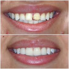 Beautiful smile transformation result